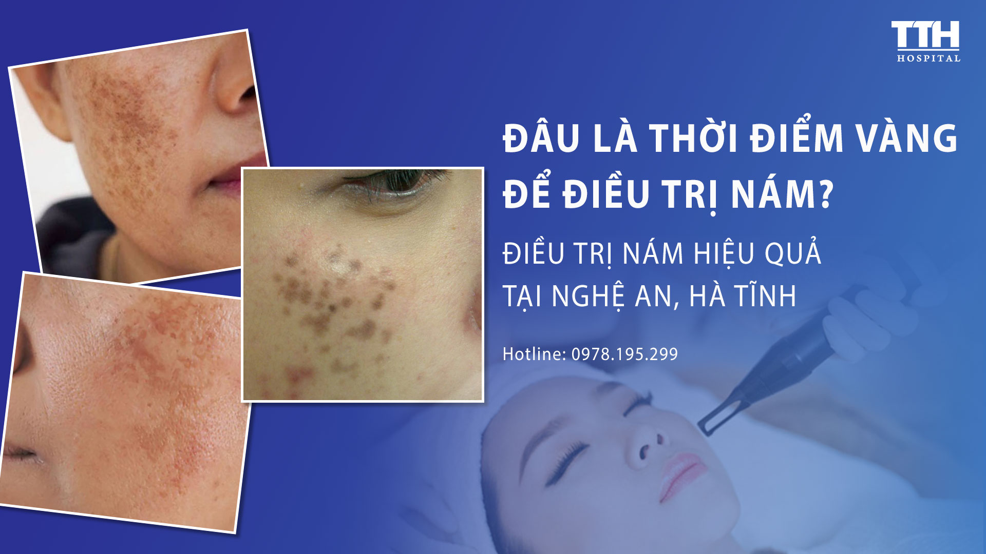 Điều trị nám hiệu quả tại Nghệ An, Hà Tĩnh - Đâu là thời điểm vàng cho trị nám?