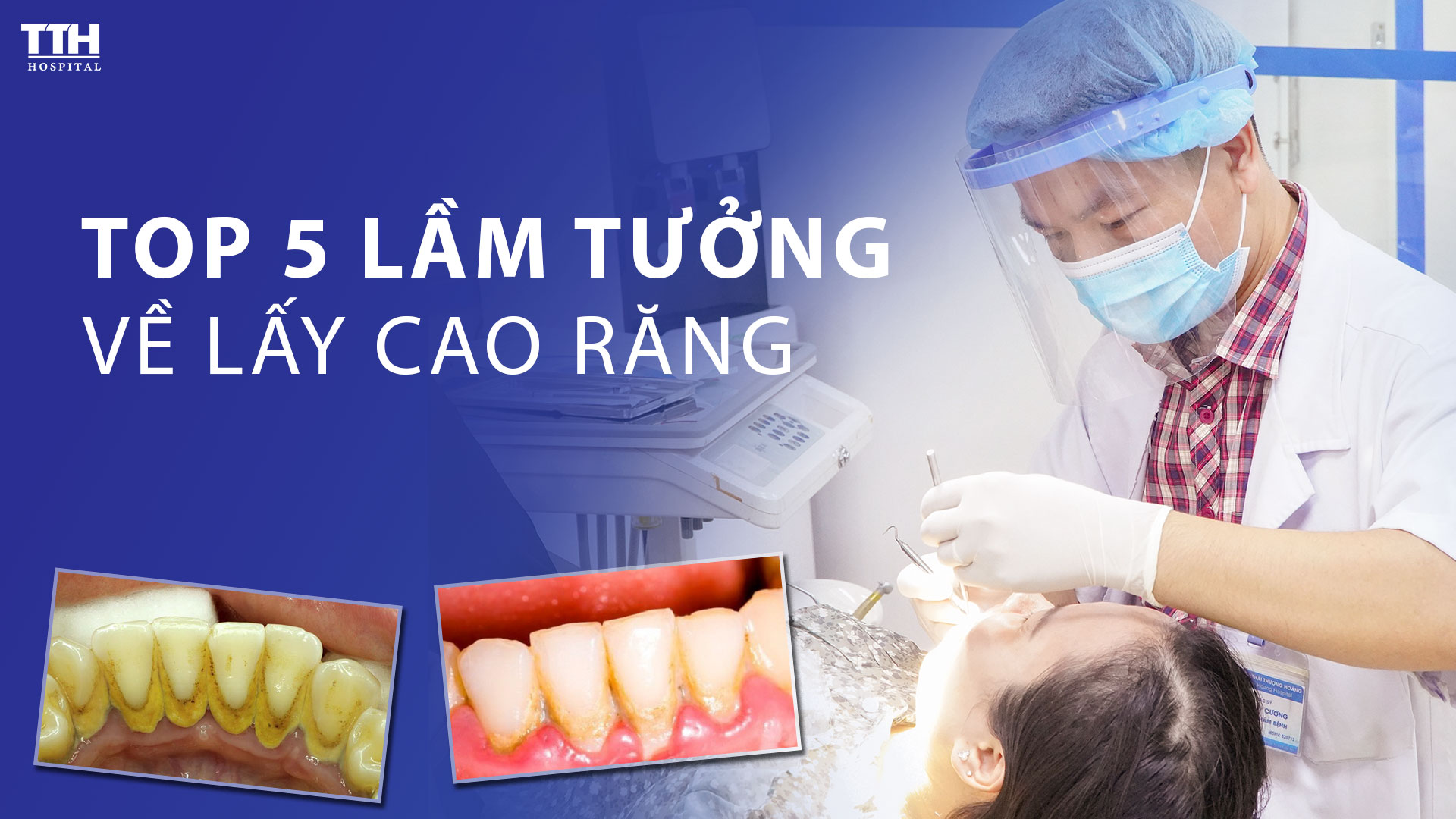 Top 5 lầm tưởng về lấy cao răng. Lấy cao răng ở đâu tại Nghệ An