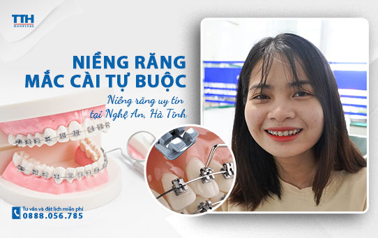 Niềng răng mắc cài tự buộc là gì? Niềng răng uy tín tại Nghệ An, Hà Tĩnh