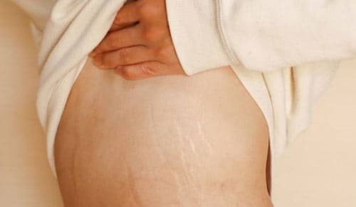 5 Sai Lầm Khiến Rạn Da Càng Trầm Trọng Hơn Ở Nam Giới