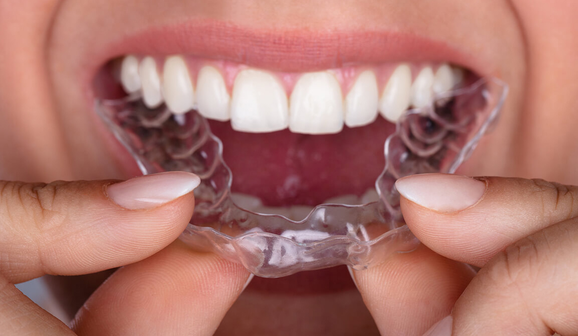 Làm Răng Sứ Xong Có Niềng Invisalign Được Không?