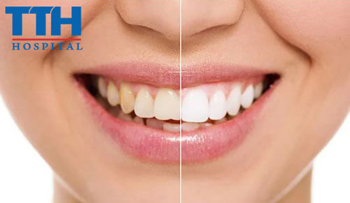 "Tạm biệt" răng ố vàng, răng trắng sáng tự tin