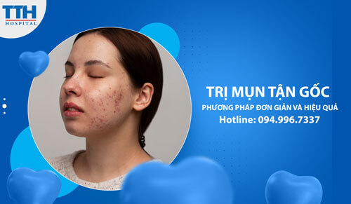 Trị mụn tận gốc: Phương pháp đơn giản và hiệu quả