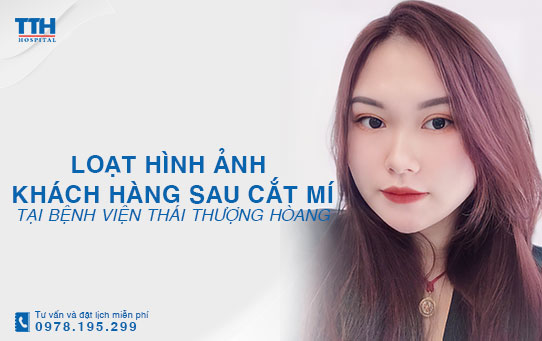 Loạt hình ảnh khách hàng sau cắt mí tại Bệnh viện Thái Thượng Hoàng - Địa chỉ thẩm mỹ uy tín Nghệ An, Hà Tĩnh