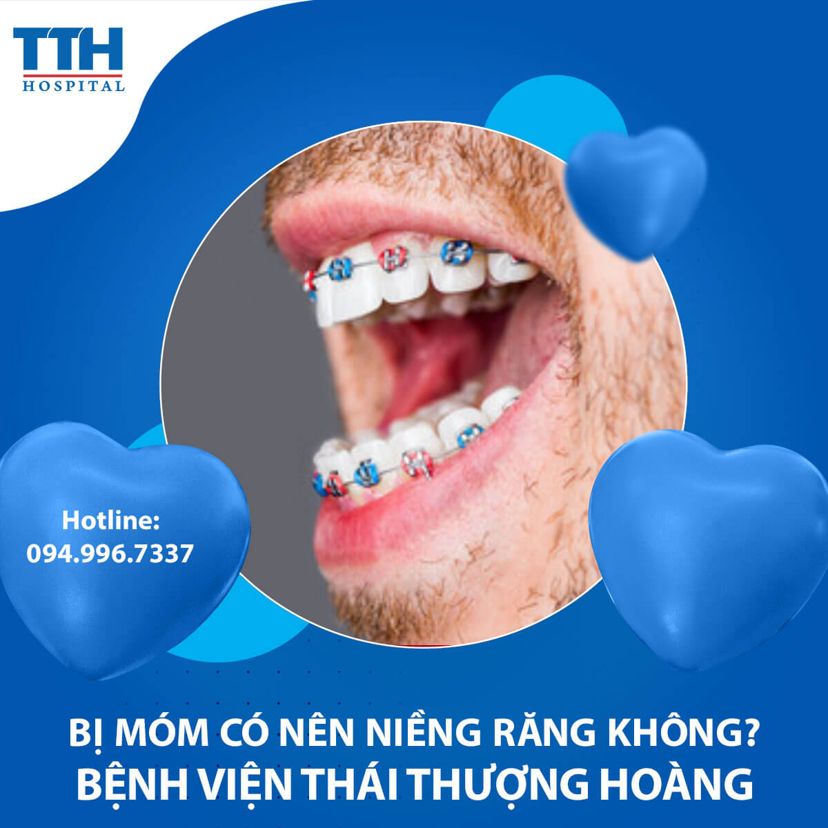 Bị móm có nên niềng răng không? Chuyên gia tư vấn