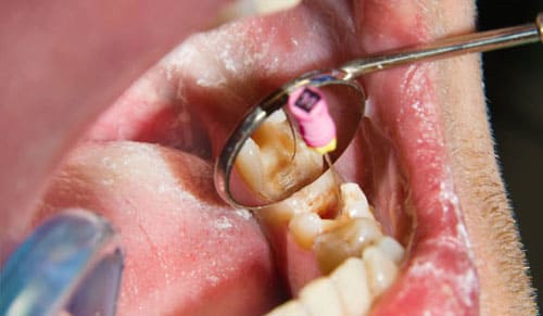 Các dấu hiệu bạn cần điều trị tủy răng