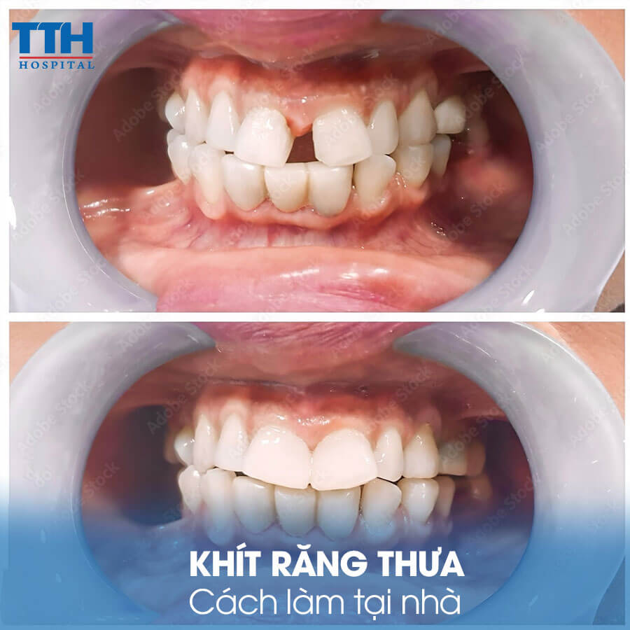 Cách làm khít răng thưa tại nhà