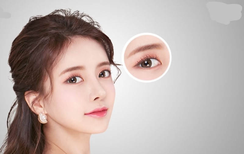 Mở góc mắt
