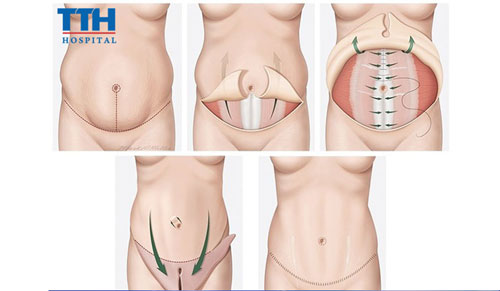 Chi phí phẫu thuật tạo hình thành bụng  bệnh viện TTH