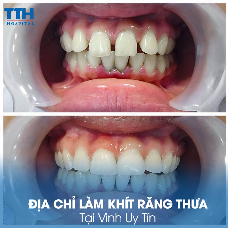 Địa chỉ làm khít răng thưa tại Vinh uy tín