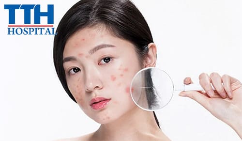 Điều trị mụn và những điều bạn chưa biết