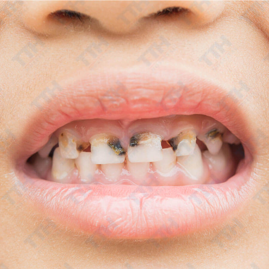 Điều Trị Sâu Răng Không Đau Đớn Với SDF: Những Điều Cha Mẹ Cần Biết