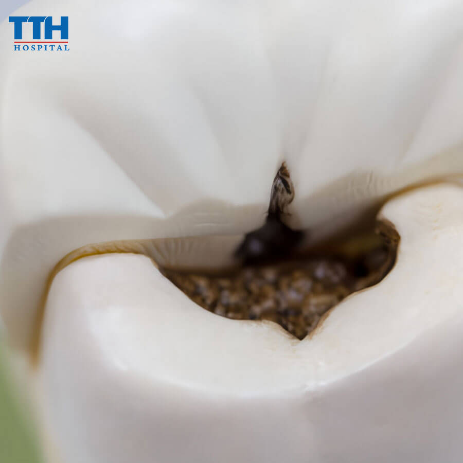 Hoại Tử Tủy Răng Là Gì?