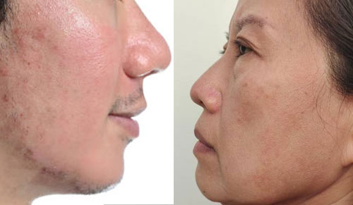 Nám Da Ở Nam Giới Khác Gì So Với Nữ Giới?