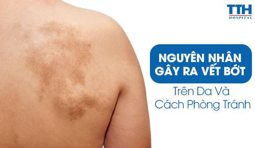 Nguyên Nhân Gây Ra Vết Bớt trên Da và Cách Phòng Tránh