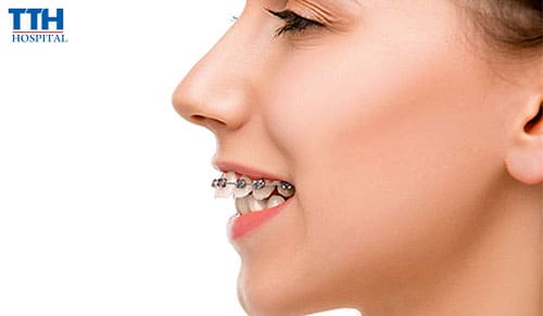 Niềng răng có làm thay đổi khuôn mặt không?
