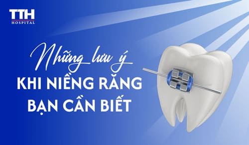 Niềng Răng Là Gì? Các Lưu Ý Khi Niềng Răng Mà Bạn Cần Biết