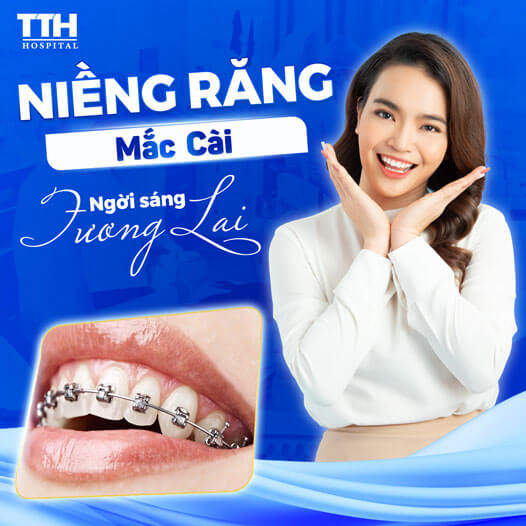 Niềng răng mắc cài