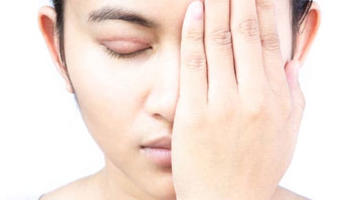 Phẫu thuật tạo hình mắt hai mí là gì? 