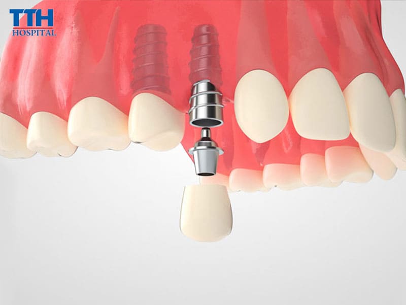 Quy trình trồng răng Implant từ A đến Z tại Bệnh viện Thái Thượng Hoàng