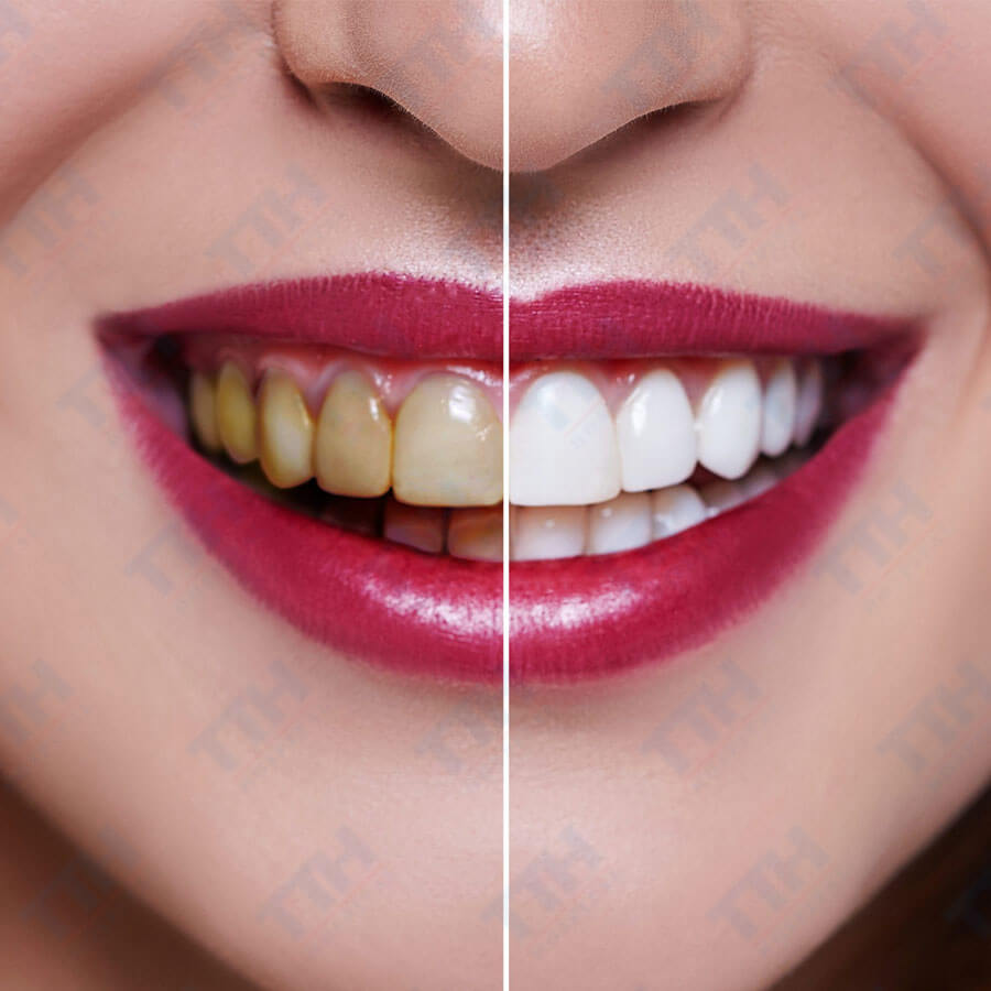 Răng Sứ Zirconia Có Thực Sự An Toàn và Hiệu Quả Không?