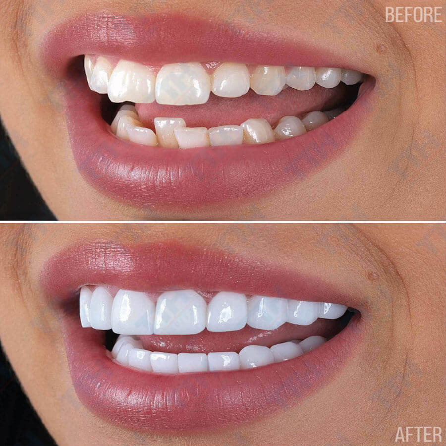 Răng Sứ Zirconia: Ưu Điểm và Nhược Điểm Cần Biết Trước Khi Lựa Chọn