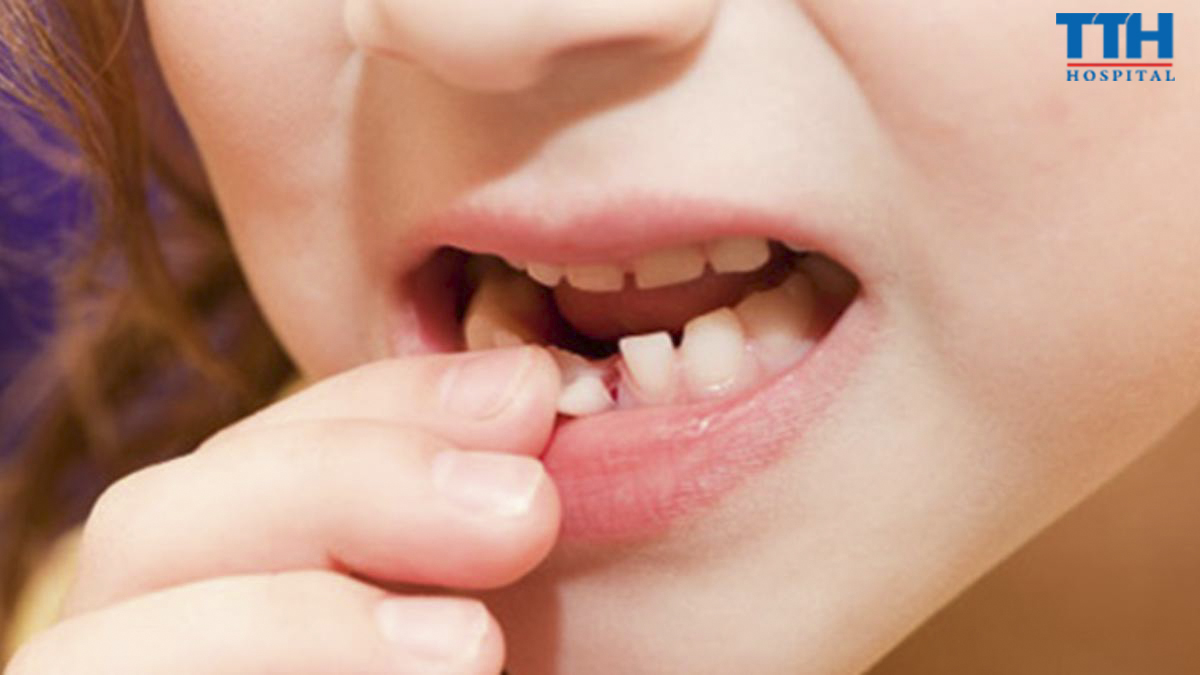 VÌ SAO KHÔNG NÊN COI NHẸ VIỆC BẢO VỆ RĂNG SỮA