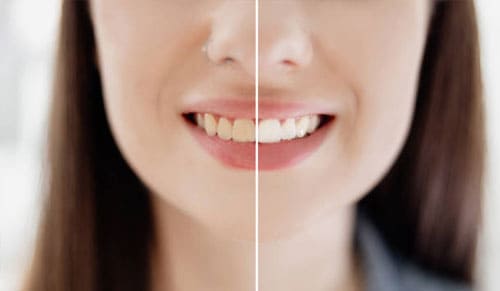 Tẩy Trắng Răng Là Gì? Khi Nào Nên Tẩy Trắng Răng?