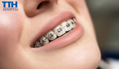 Thời điểm niềng răng phù hợp nhất là khi nào?
