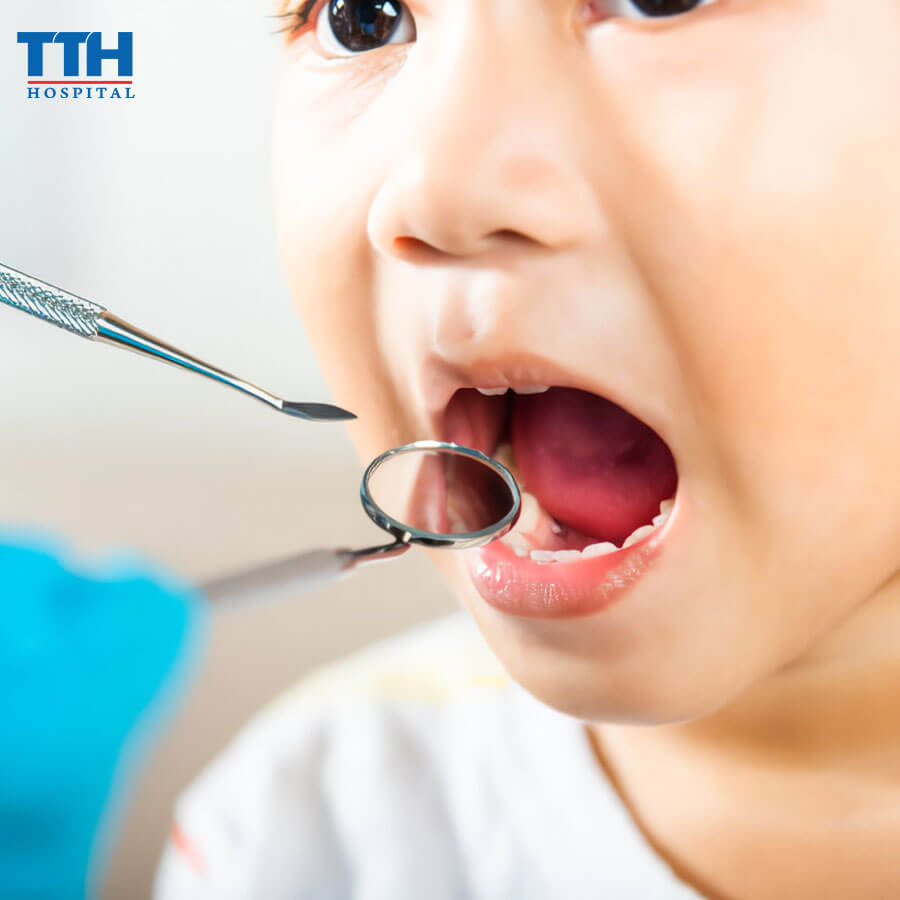 Thời Gian Ngừa Sâu Răng Trẻ Em Của SDF Là Bao Lâu?