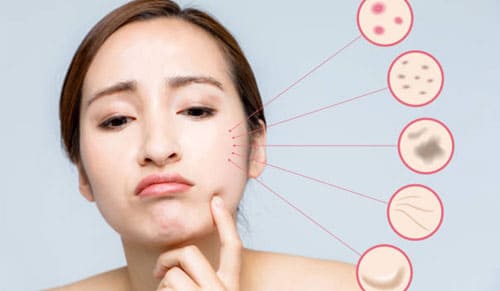 Vì Sao Da Dễ Nổi Mụn Hơn Vào Dịp Cuối Năm?