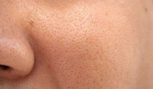 Vì sao lỗ chân lông thường to hơn vào dịp cuối năm?