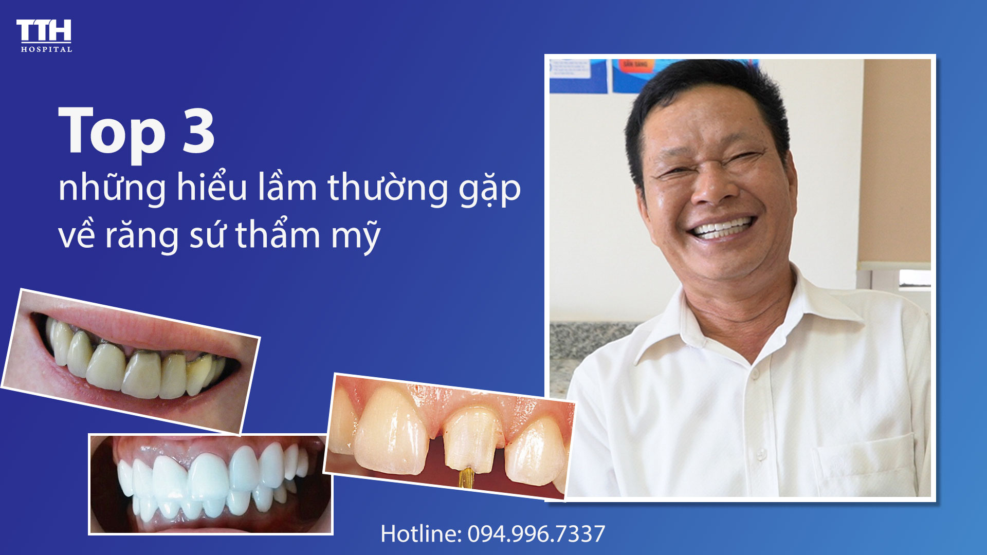 Top 3 những hiểu lầm thường gặp về răng sứ thẩm mỹ