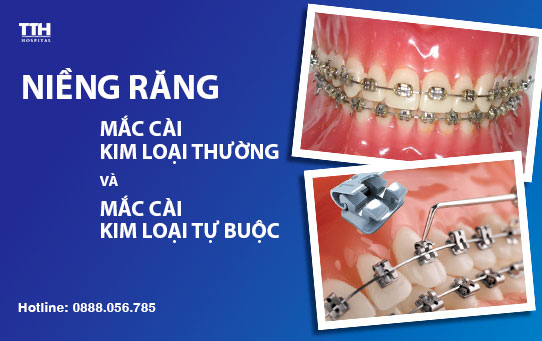 Niềng răng mắc cài kim loại thường và niềng răng mắc cài kim loại thông minh