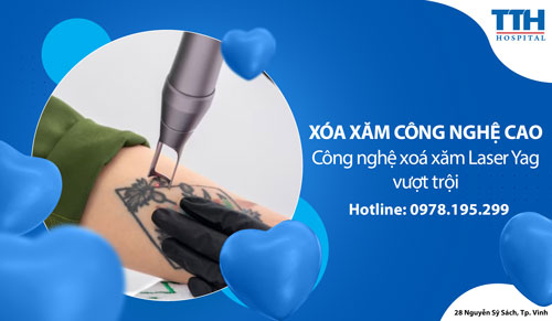 Xóa xăm công nghệ cao