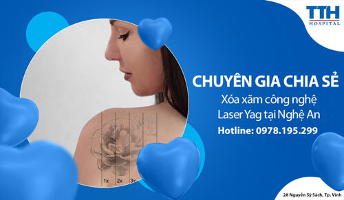 Xóa xăm công nghệ Laser Yag tại Nghệ An
